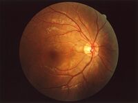 picture of an eye fundus, By ignis - Own work, CC BY-SA 3.0, https://commons.wikimedia.org/w/index.php?curid=1707516